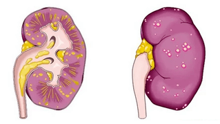 ce qui cause la prostatite aiguë