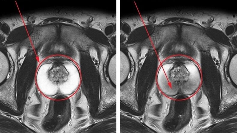 une prostate saine et enflammée avec prostatite chronique